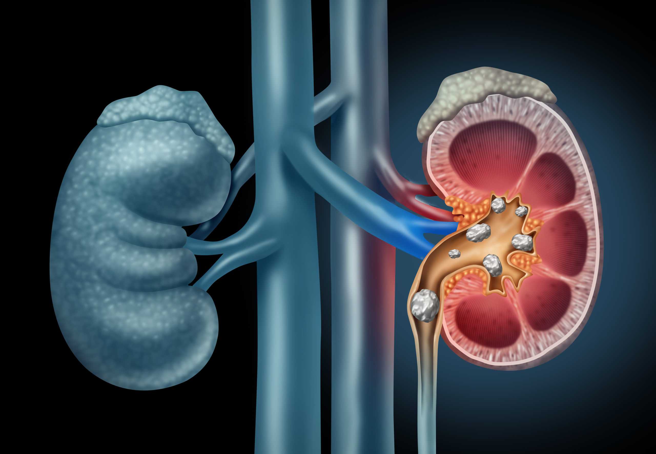 Kidney Health Dialysis